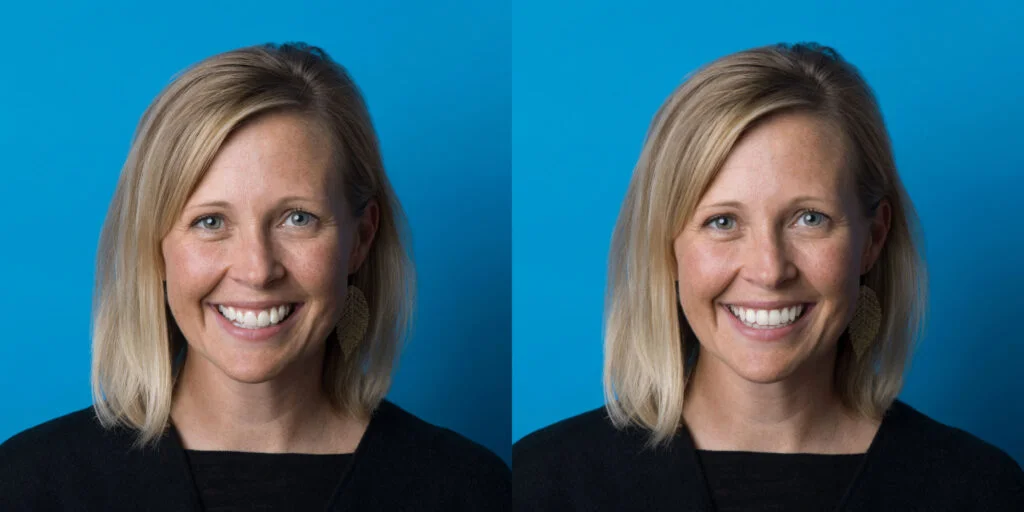 Smile View Before/ After Smile View Before/ After