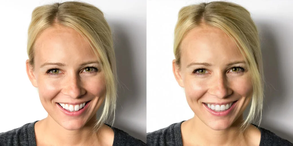 Smile View Before / After Smile View Before / After