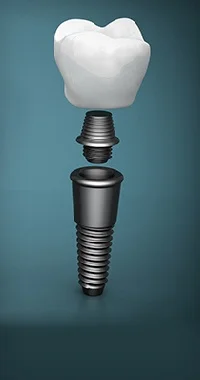 Dental Implants