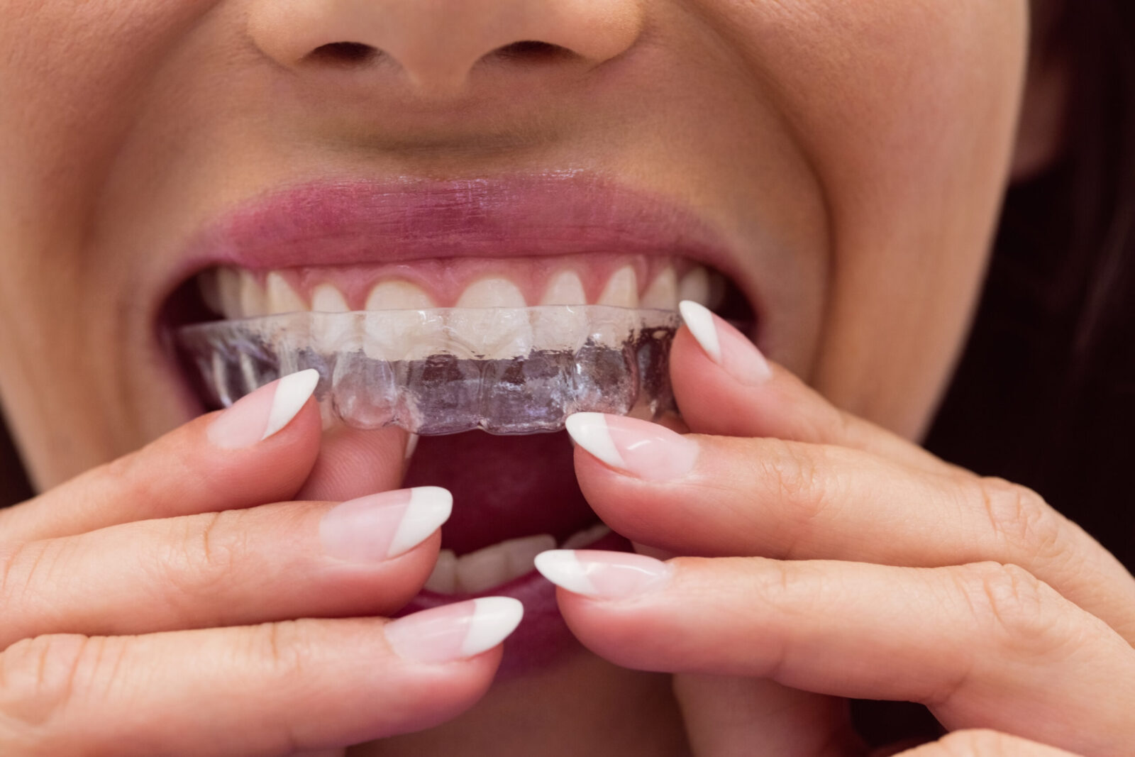 Best Invisalign orthodontist Dentist in Leesburg, Ashburn