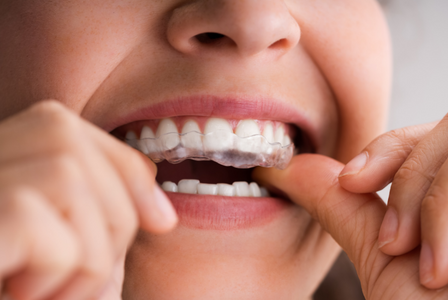 Invisalign Ashburn Invisalign Ashburn