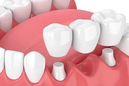 What Is Dental Bridge?