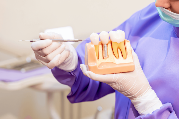 Are Dental Implants Worth It?