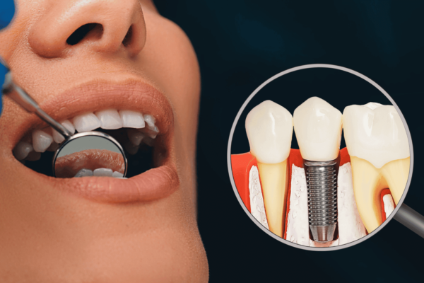 Dental Implant Procedure: A Step-by-Step Process