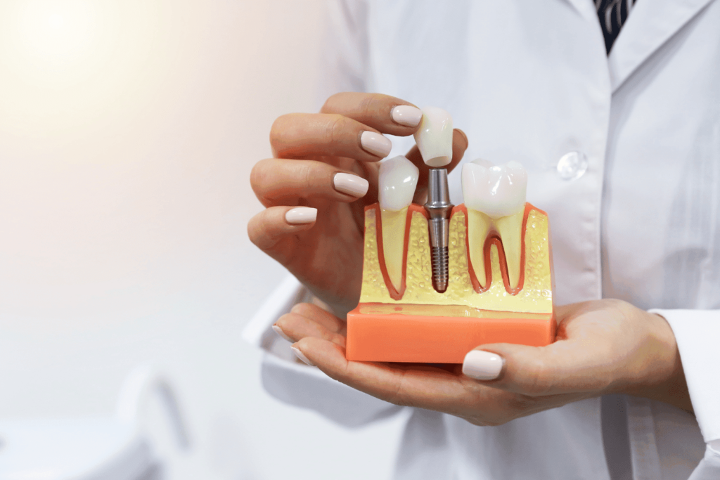 What is a Dental Implant