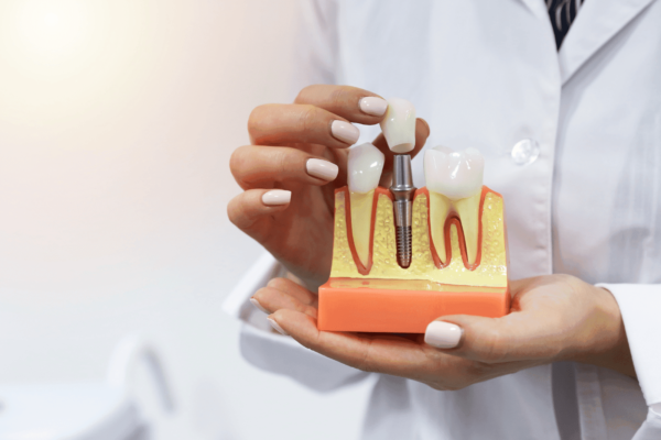 What is a Dental Implant?