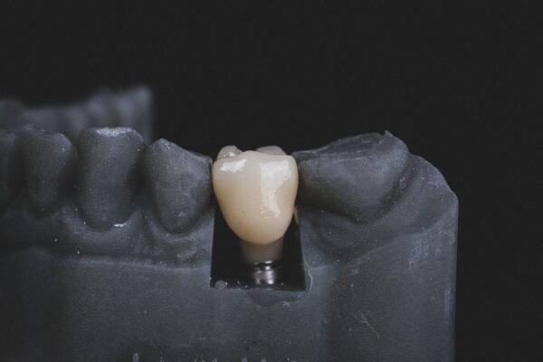 What Is A Tooth Implant?