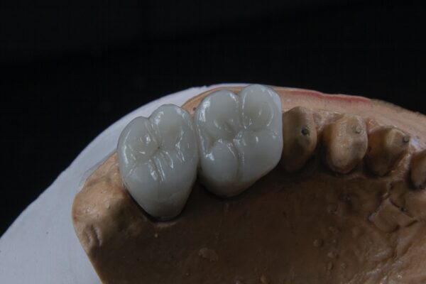 Dental Crown Dentist | Dr. Wael Elosta