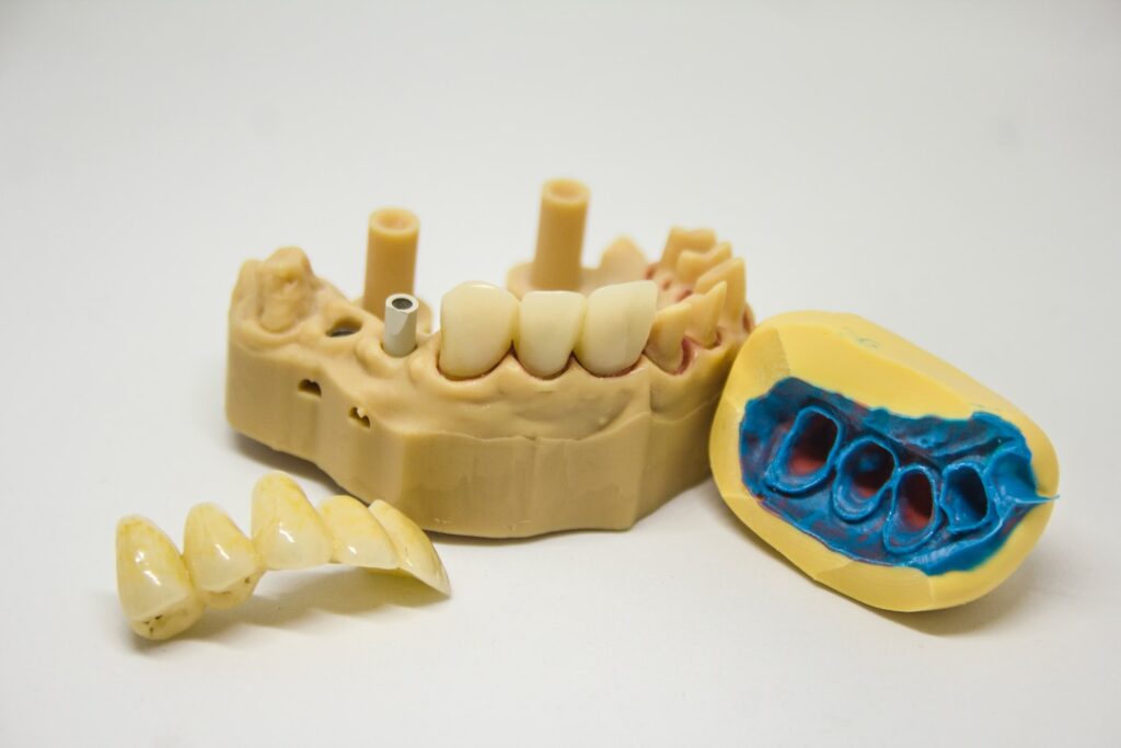 dental implant vs bridge