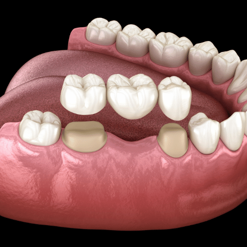 Dental Bridge Leesburg Dental Bridge Leesburg