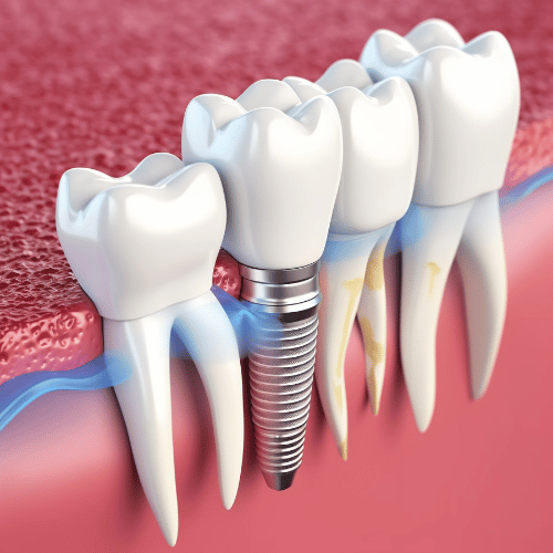 Dental Implants Leesburg Dental Implants Leesburg VA