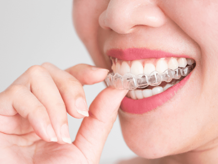 Invisalign Leesburg VA