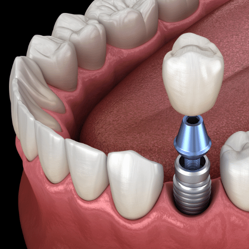 tooth implant