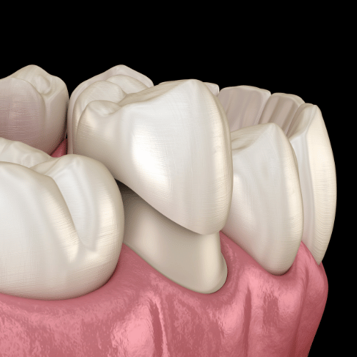 Dental Crown Leesburg