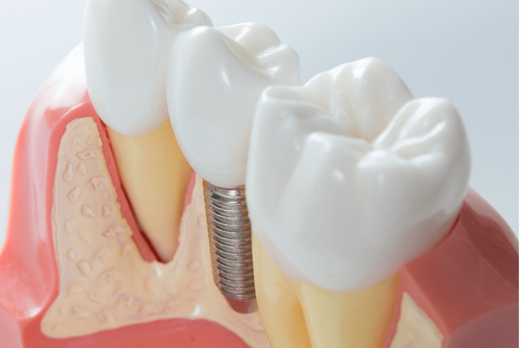 Endosteal Dental Implants
