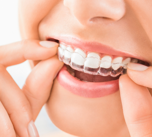 Invisalign Teeth Straightening Invisalign Teeth Straightening