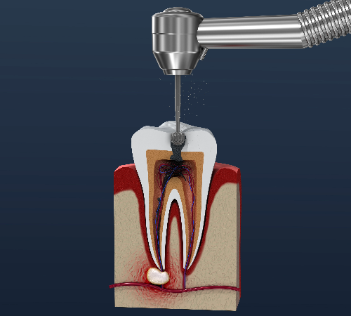 Root Canal Root Canal