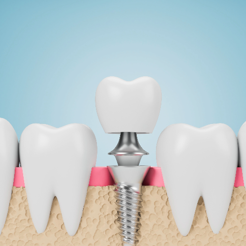 Tooth Extraction and Implant