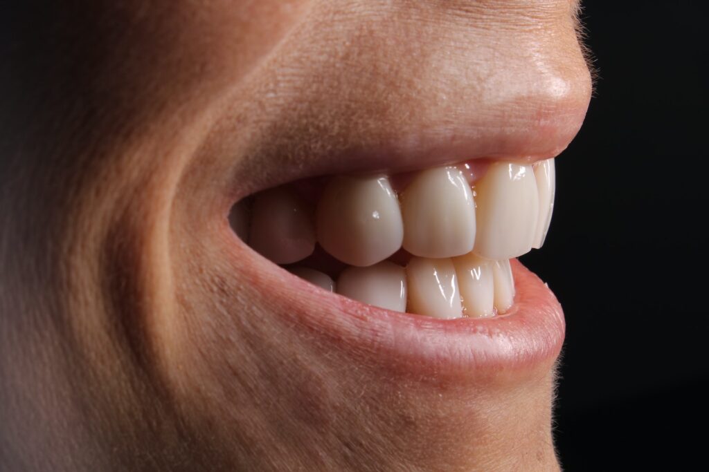 Whitening Dental Implants Tips