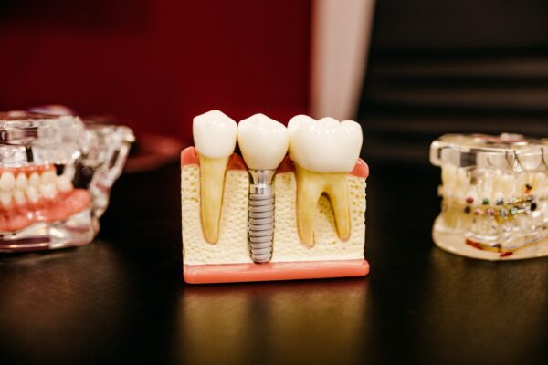 Dental Implants & Abutments: Complete Tooth Replacement Solutions