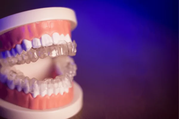 Can Invisalign Fix Overjet?