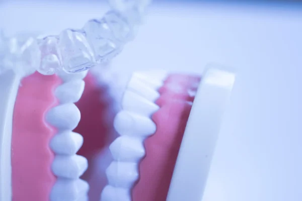 Invisalign vs. Veneers