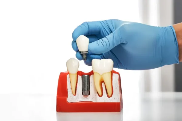 How to Choose the Best Ashburn Dentist for Dental Implants?