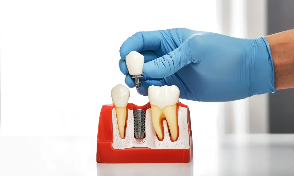 Ashburn Dentist for Dental Implants