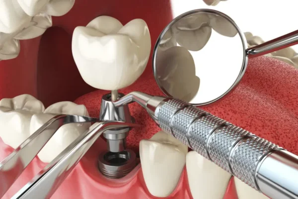 How to Choose the Best Leesburg Dentist for Dental Implants?