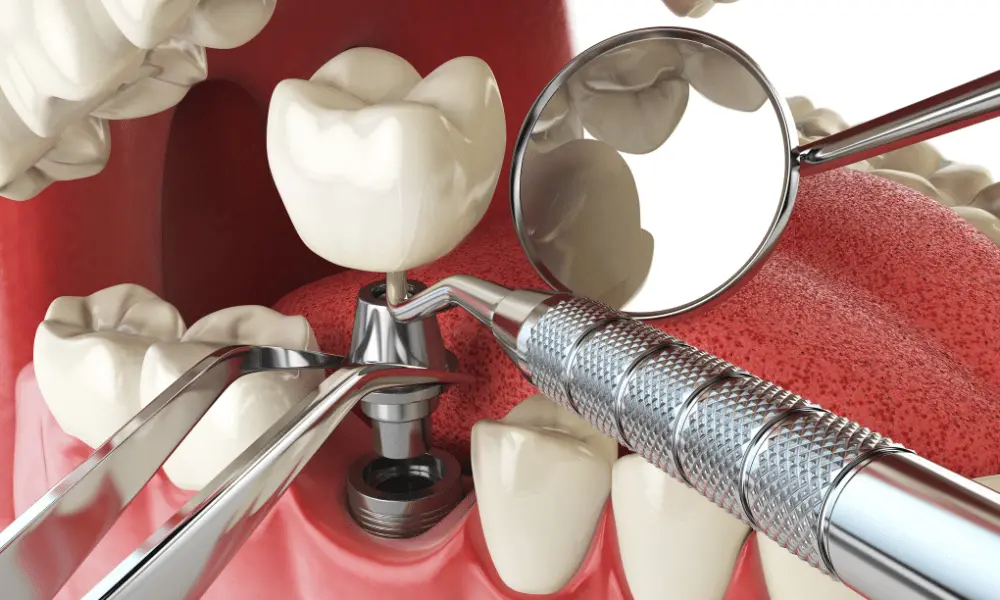 Leesburg Dentist for Dental Implants