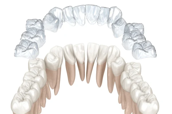 Losing a Tooth and Invisalign: What You Need to Know