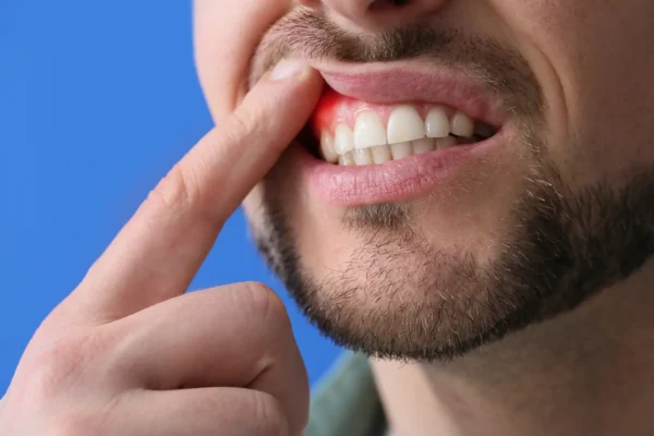 How To Prevent Bleeding Gums?